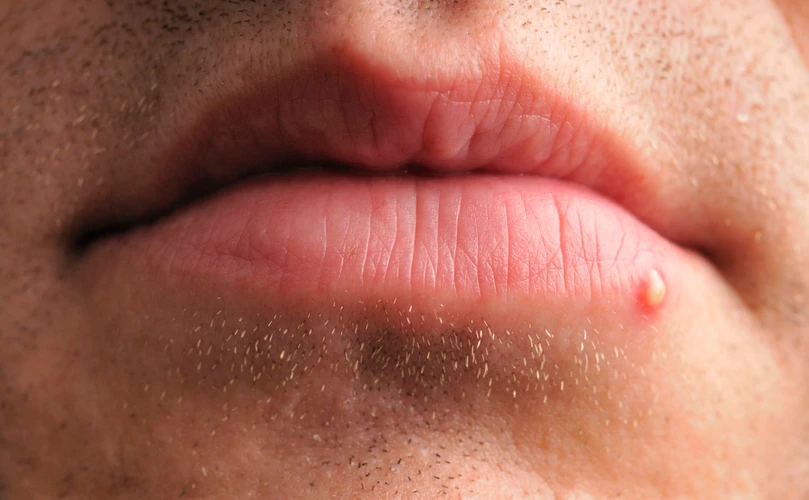 Cara Menghilangkan Jerawat di Bibir Dengan Cepat