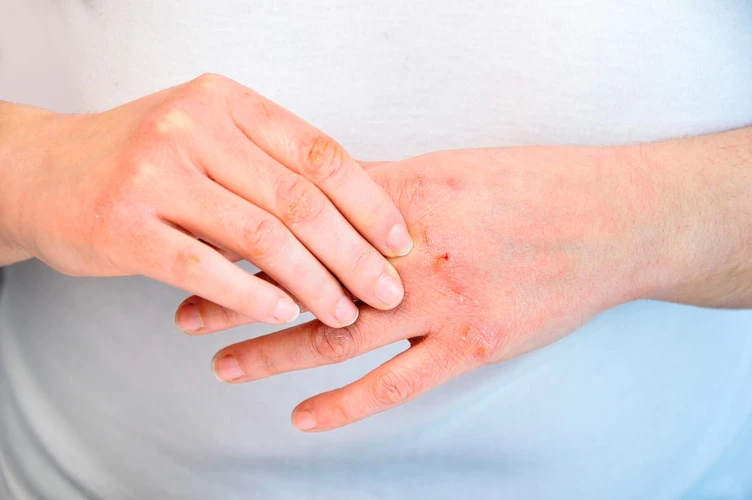 Kenali 4 Macam Alergi & Bagaimana Cara Mengatasinya 