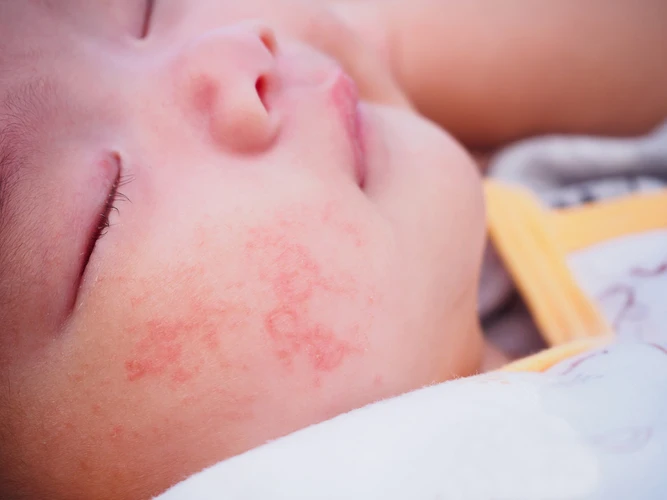Mencubit Pipi Bayi Bisa Jadi Penyebab Dermatitis Atopik, Benarkah?