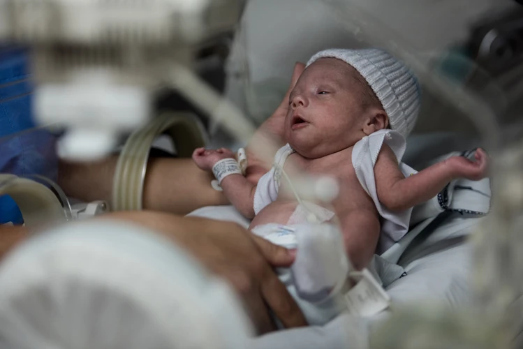 Gangguan Paru-Paru pada Bayi Prematur