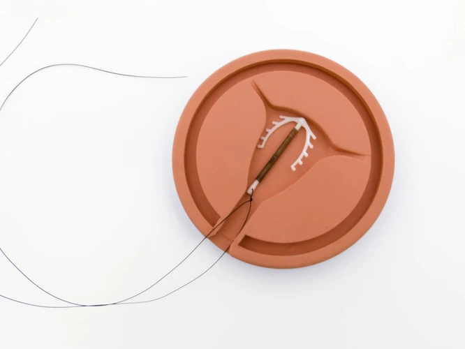 Apa Solusi Jika Benang IUD (KB Spiral) Tidak Terasa?