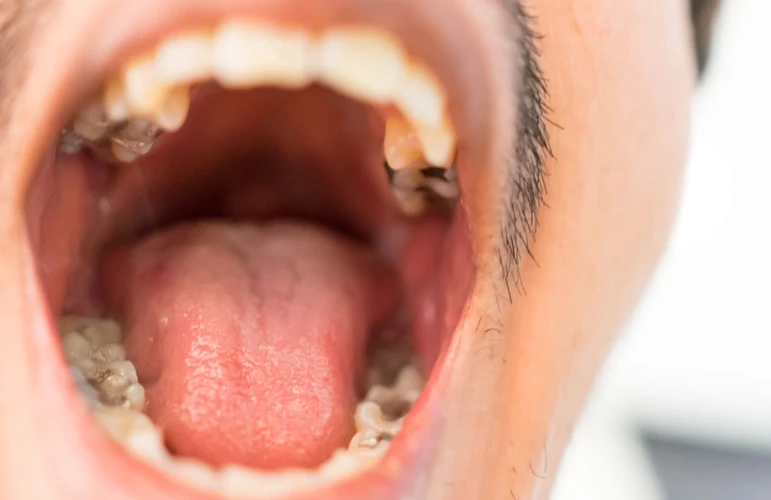 Apakah Oral Sex Bisa Menyebabkan Kanker Mulut