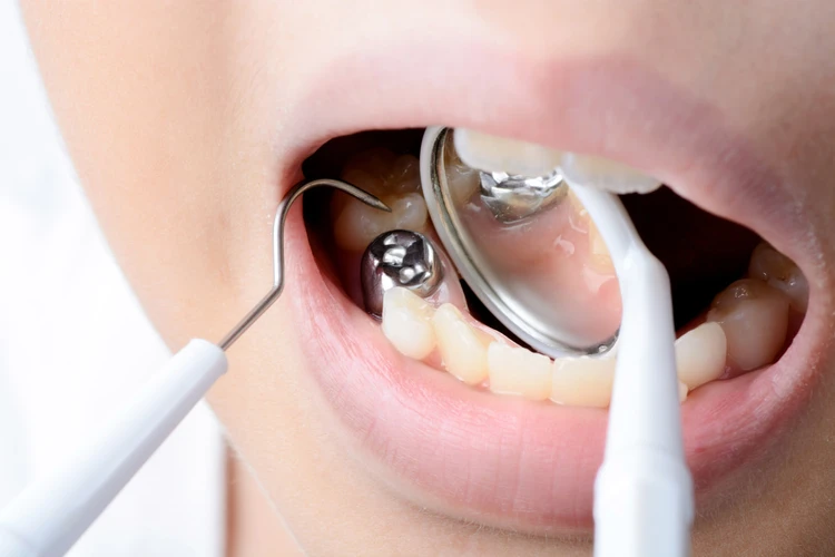 5 Jenis Tambal Gigi Paling Umum di Dokter Gigi