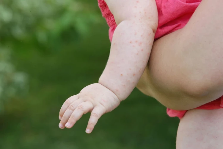Pemicu Alergi Pada Anak: Apa Saja? 