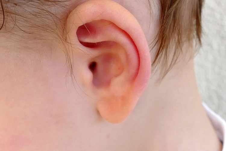 Telinga Berair Pada Anak: Penyebab, Gejala, dan Obat