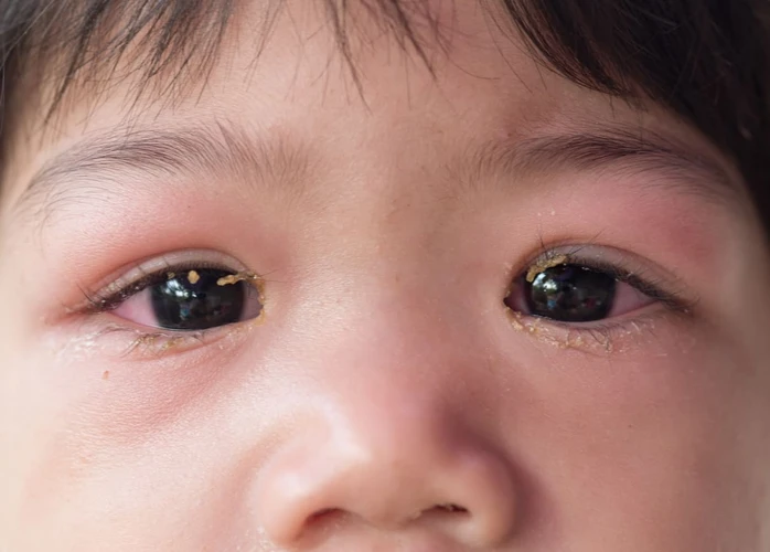 Mata Bernanah Pada Anak: Penyebab, Gejala, dan Obat