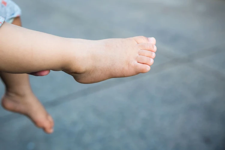 Flatfoot Pada Anak: Penyebab, Gejala, dan Obat