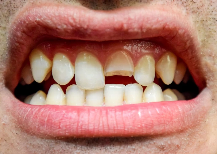 Berbagai Hal yang Bisa Menyebabkan Gigi Mudah Patah, Plus Tips Pencegahannya
