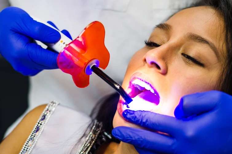 Berapa Lama Efek Memutihkan Gigi di Dokter Bisa Bertahan?