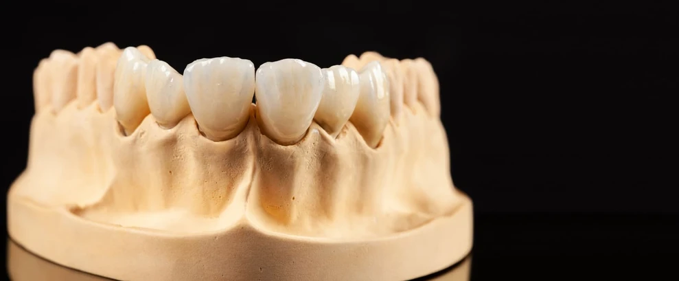 Kondisi Gigi yang Bisa Di-Veneer dan Tidak Menurut Ahli