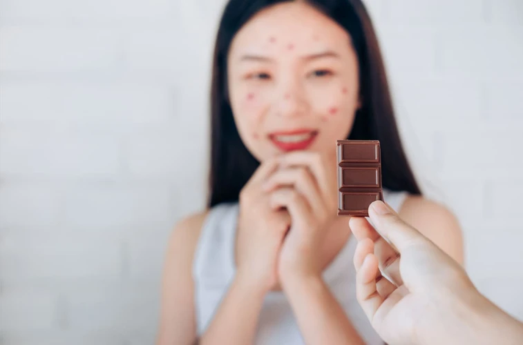 Apakah Benar, Makan Coklat Kebanyakan Bisa Bikin Jerawatan?