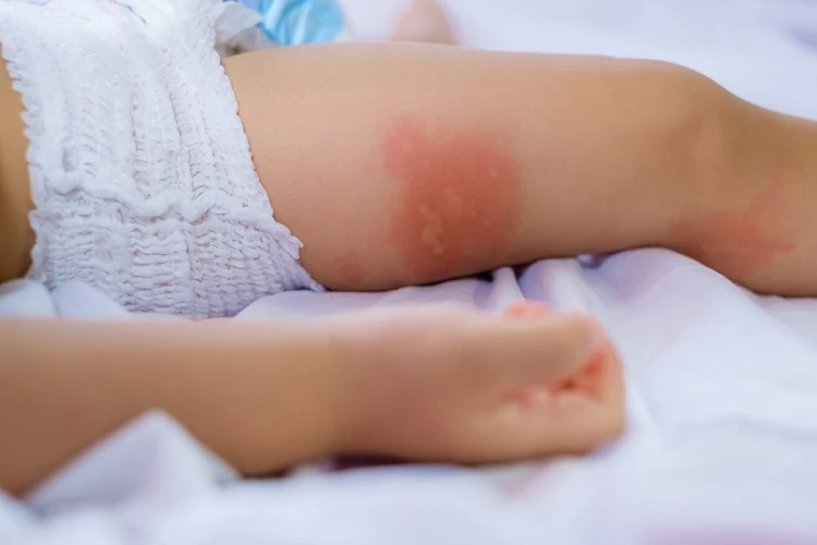 Infection Exposure Questions Pada Anak: Penyebab, Gejala, dan Obat