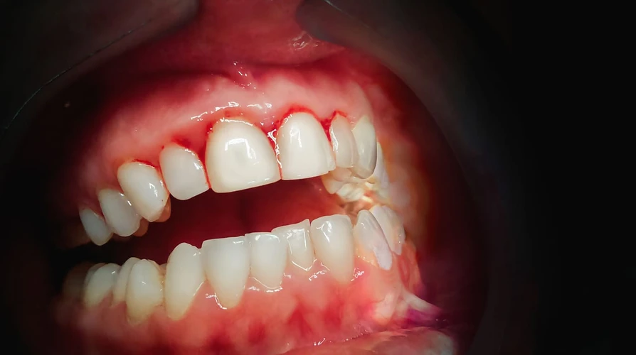Kenali 3 Tanda Ini yang Menunjukkan Gigi Anda Sebentar Lagi Akan Tanggal