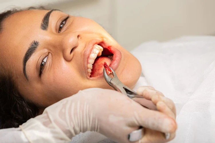 Cabut Gigi Ketika Sedang Haid Tidak Disarankah Oleh Dokter