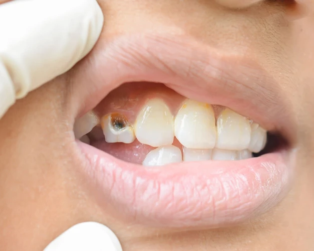 Mencegah Cidera pada Mulut dan Gigi