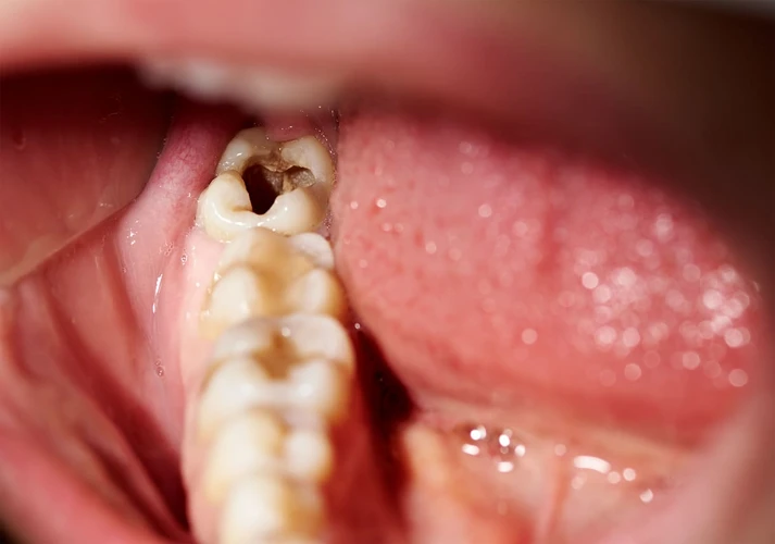 Cara Yang Tepat Untuk Mencegah Terjadinya Pembusukan Gigi 