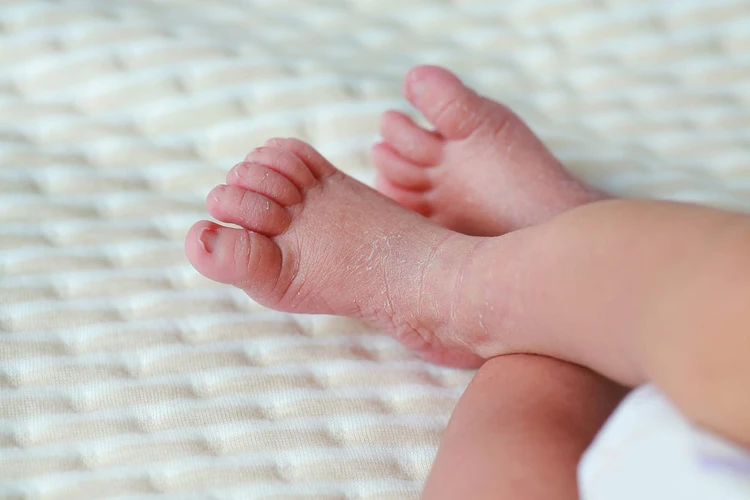 Mengapa Kulit Bayi Baru Lahir Kering dan Mudah Terkelupas?
