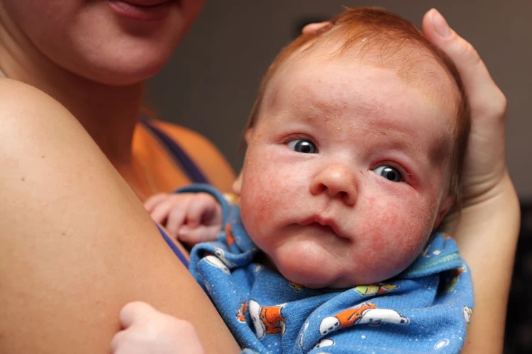 Penyebab Alergi pada Bayi dan Cara Mengatasinya