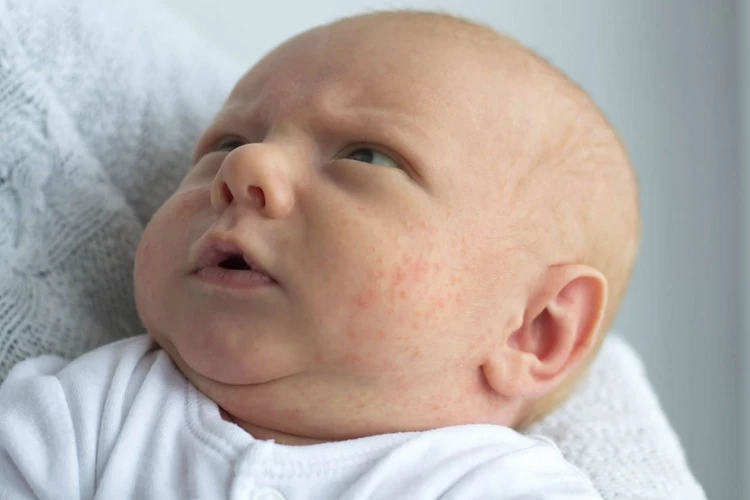 Kenali Penyebab, Gejala, dan Cara Mengatasi Alergi Pada Bayi 