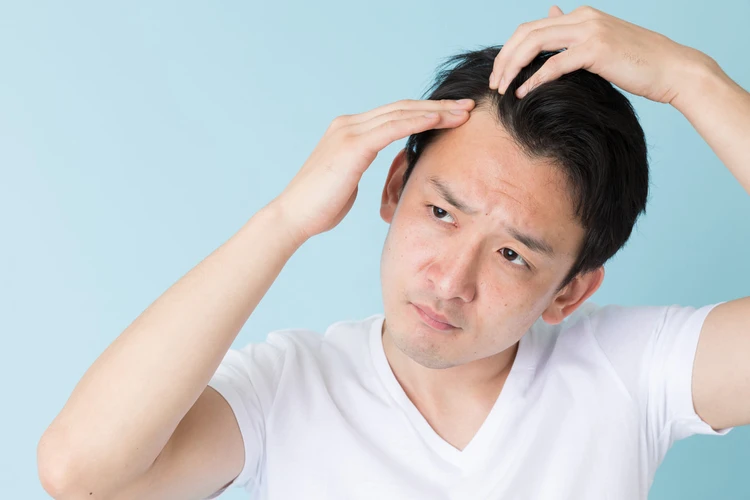 Rambut Botak Bikin Tak Percaya Diri? Kenali Penyebab dan Cara Mengatasinya