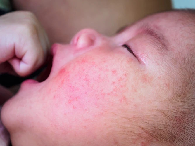 Bintik Merah pada Wajah Bayi: Penyebab dan Cara Mengatasinya