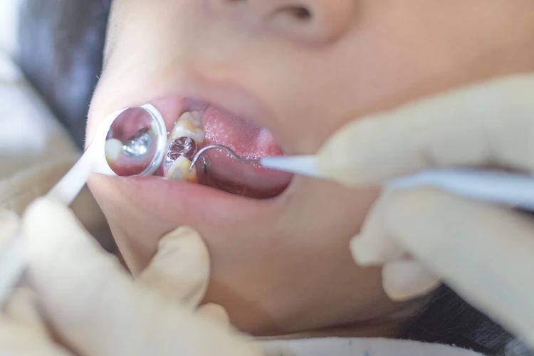Kupas Tuntas Tambal Gigi, dari Jenis Sampai Perawatannya