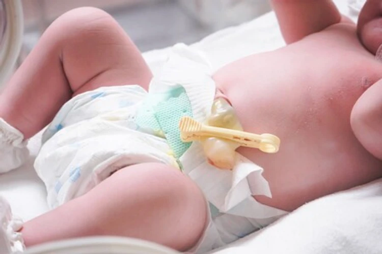 Begini Cara Benar Merawat Tali Pusat Bayi Baru Lahir