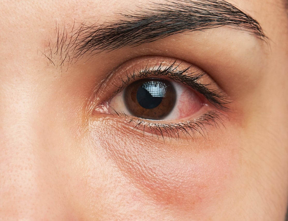 16 Penyebab Mata Merah dan Cara Mengobatinya | HonestDocs