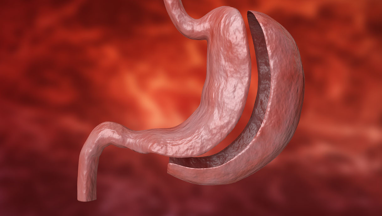Mengenal Prosedur Sleeve Gastrectomy Untuk Mengurangi Berat Badan HonestDocs