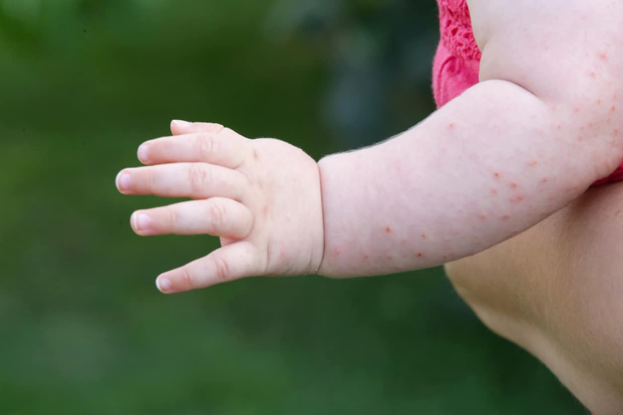 Penyebab dan Cara Mengatasi Bintik Merah Pada Kulit Bayi | HonestDocs
