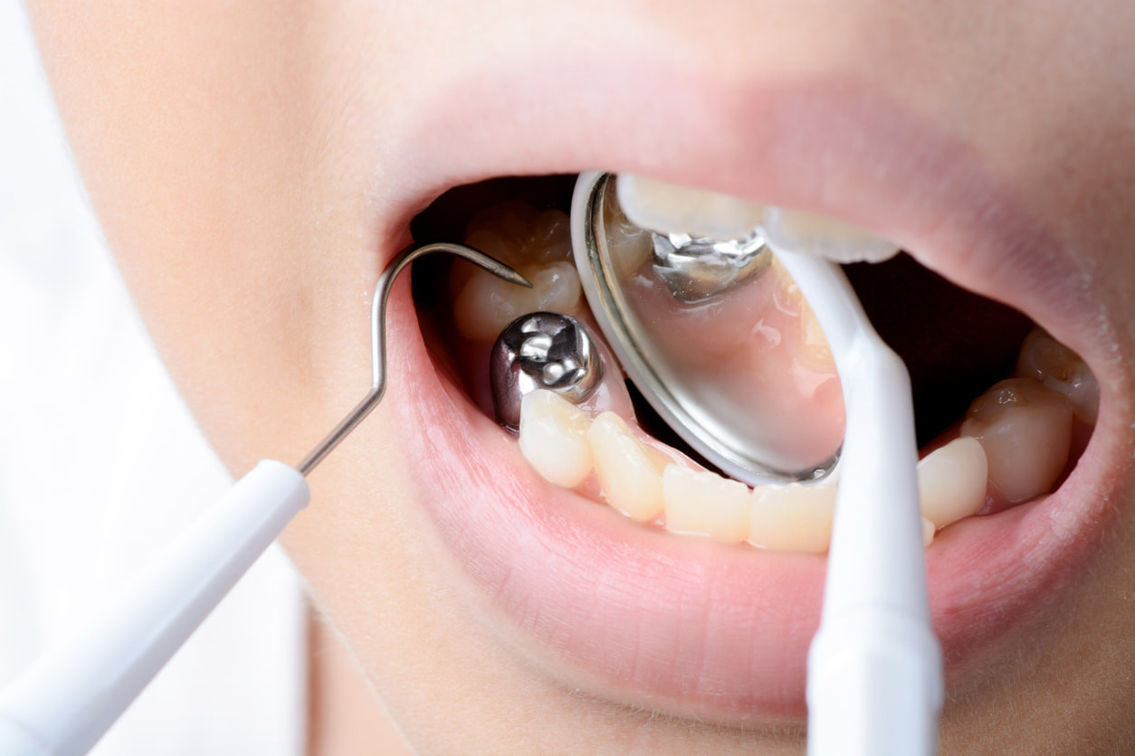 Prosedur dan Biaya Tambal Gigi