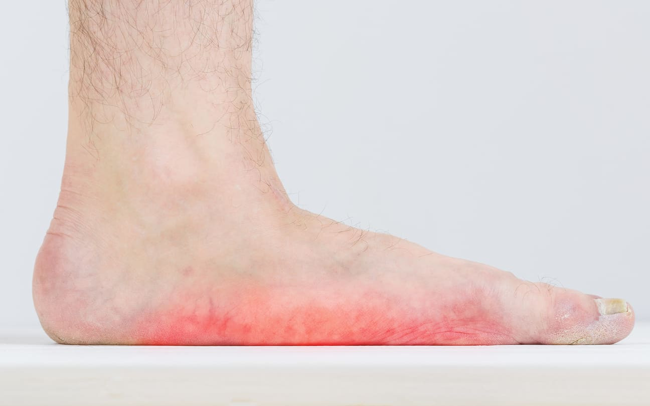 Flat Feet: Treatment, Causes & More