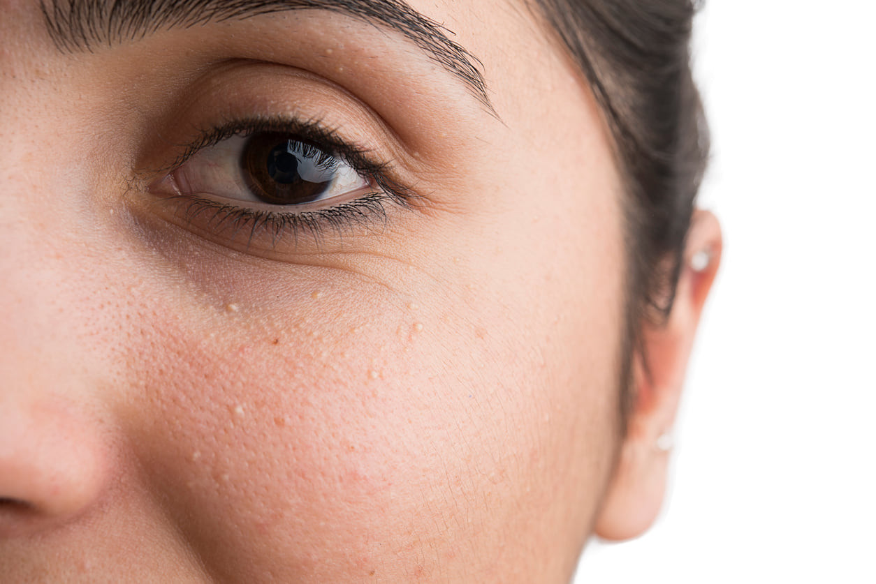 Cara Menghilangkan Bintik Putih di Wajah dan Bawah Mata | HonestDocs