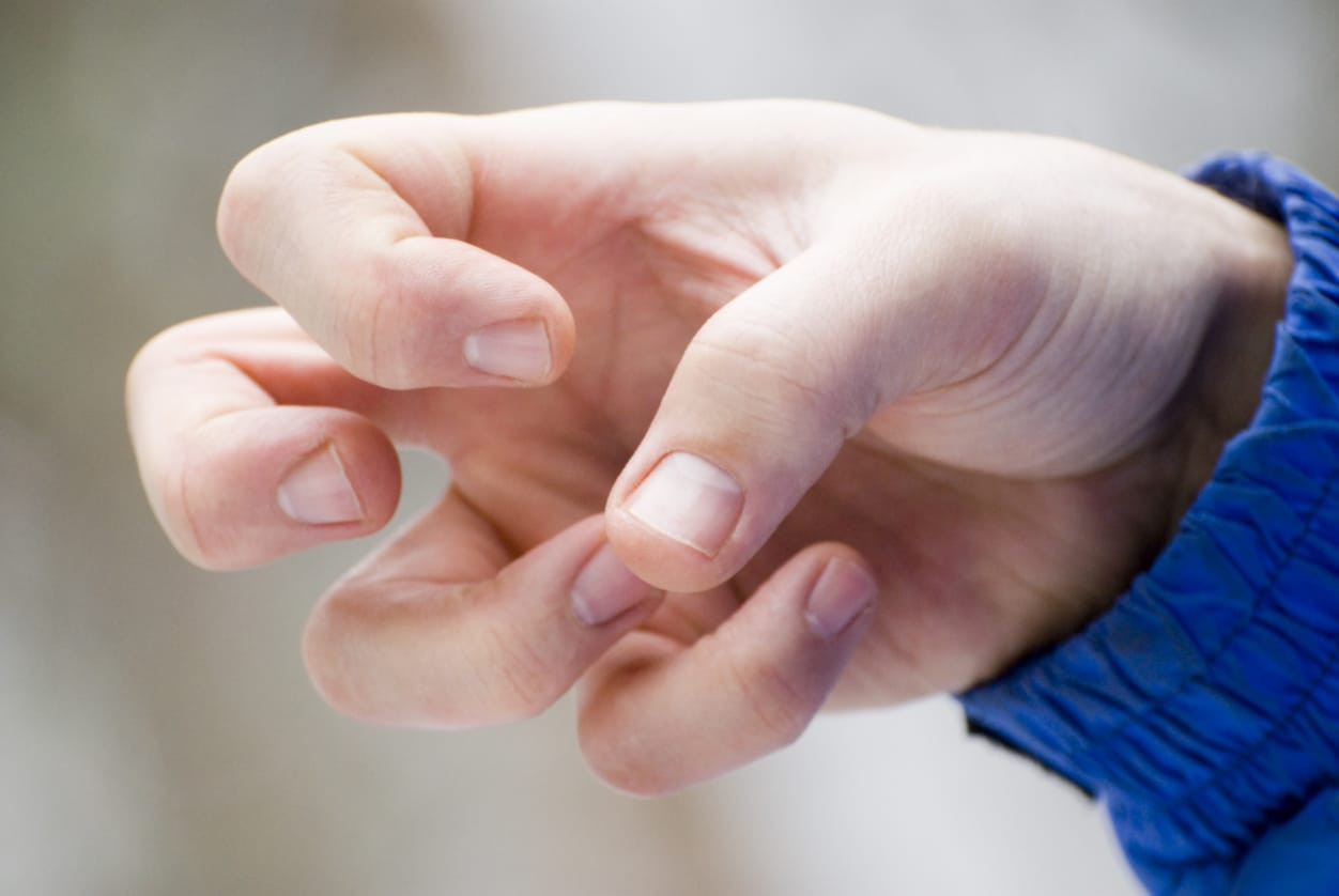 Epilepsi Gejala, Cara Menangani, dan Obat HonestDocs