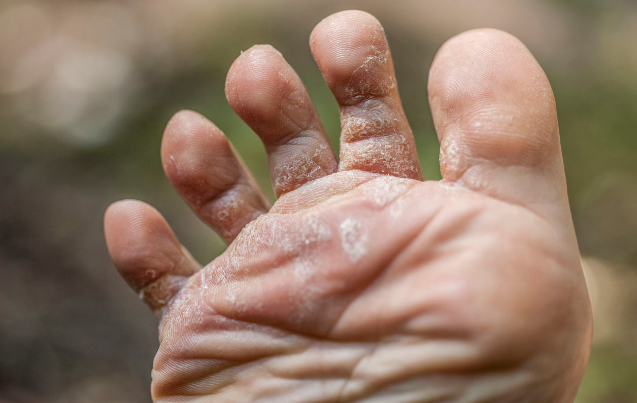 Tinea Pedis Adalah? - Tanda, Penyebab, Gejala, Cara Mengobati | HonestDocs