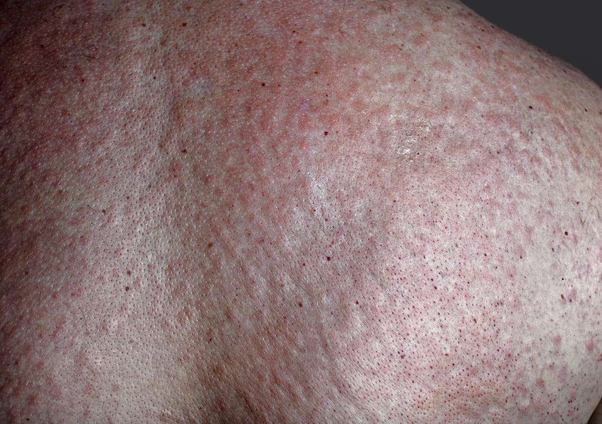 Pityriasis Rosea Adalah? - Tanda, Penyebab, Gejala, Cara Mengobati ...