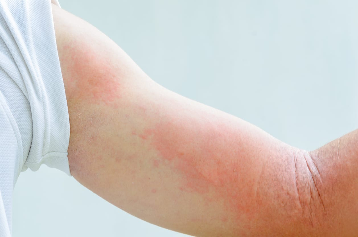 Dermatitis Kontak Alergi Adalah? - Tanda, Penyebab, Gejala, Cara Mengobati  | HonestDocs