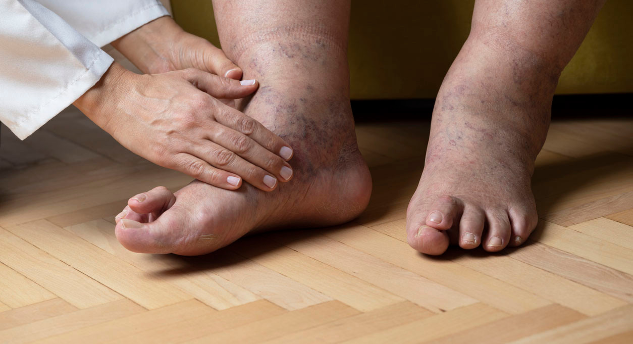 Filariasis Adalah? - Tanda, Penyebab, Gejala, Cara Mengobati | HonestDocs