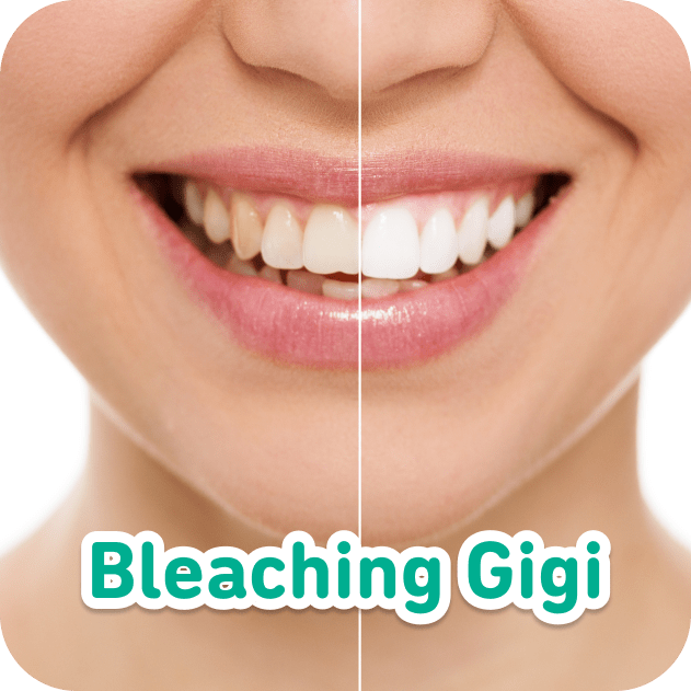 HDReview: Bleaching Gigi para Customer