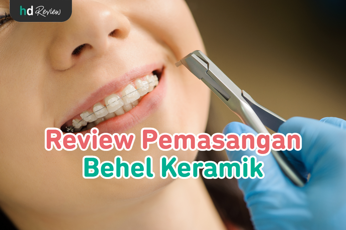 Pemasangan Behel Keramik reviews